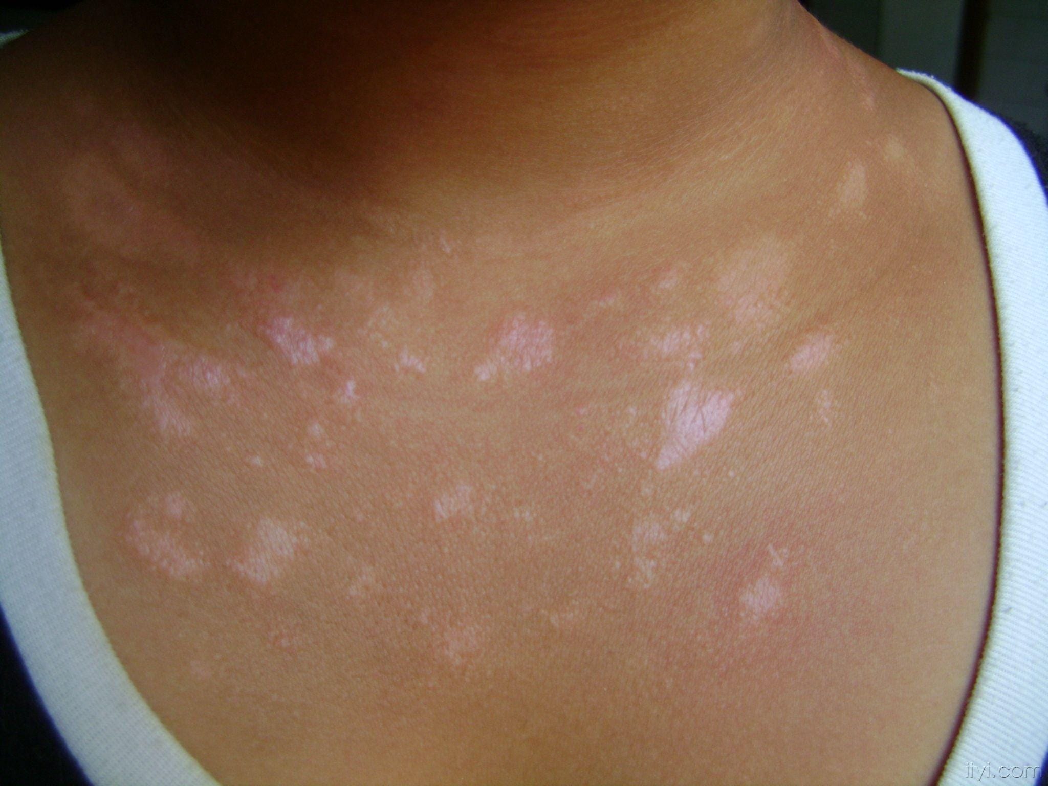 各种皮肤病图片大全 8种常见皮肤病对应的外涂药膏_华夏智能网