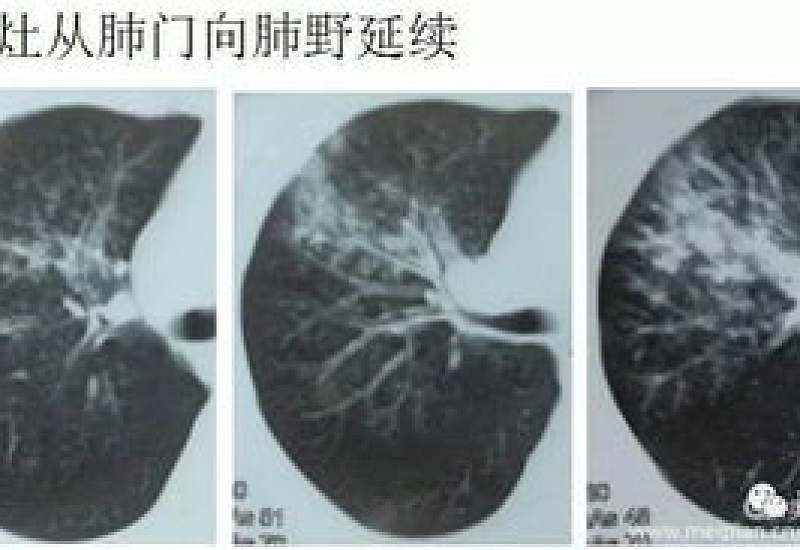 支原体肺炎对肺部有影响吗